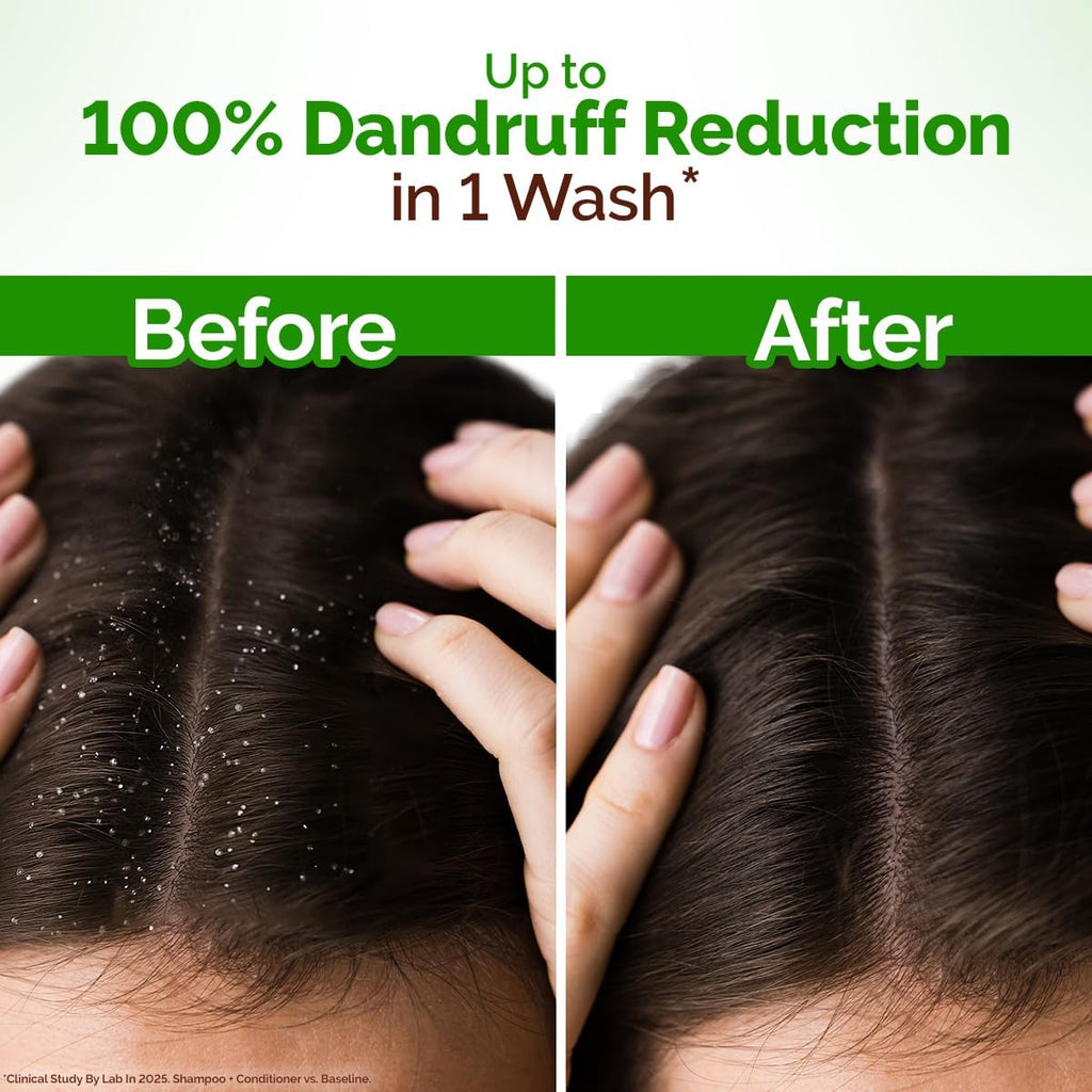 Mamaearth Lemon Anti-Dandruff Shampoo with Lemon, ZPTO, Climbazole, Aloe Vera for Itchy & Flaky Scalp | Upto 100% Dandruff Reduction & 3X Softer Hair in 1 Wash